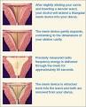 NovaSure Endometrial Ablation * Heavy Periods * Obstetrics And ...