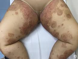 Image result for tinea corporis