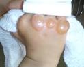 Burn treatments - Scar prevention - CareCure Forums