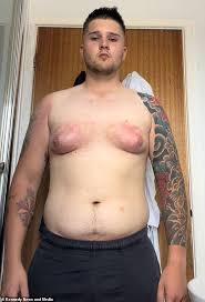 Image result for manboobs