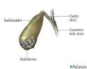 <b>Gallstones</b>