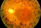 <b>Retinitis Pigmentosa</b>