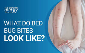 Image result for bed bug bites