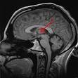 <b>Thalamus</b>