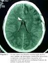 de <b>edema</b> cerebral são