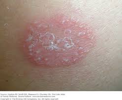 Image result for tinea corporis