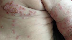 Attēlu rezultāti vaicājumam “Diderma simplex”