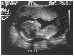 ultrasound side Ultra sound pictures.