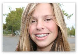 braces pictures