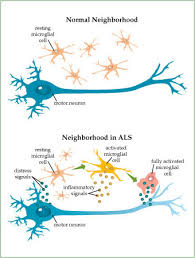 Posts Related to ALS and who