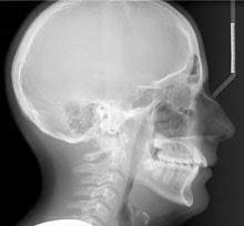 cephalometric radiograph