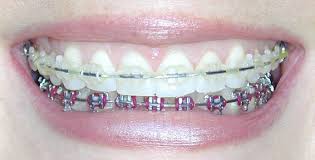 braces pictures