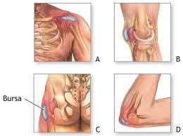 bursitis hip