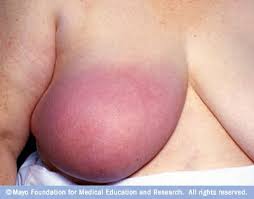 Inflammatory breast cancer