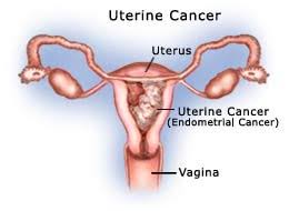 uterus cancer