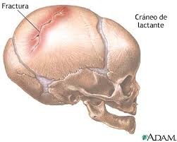 fractura de craneo