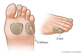 corn pads