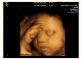 3d sonogram pictures