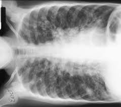 Cystic Fibrosis.