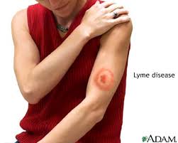 symtoms lyme