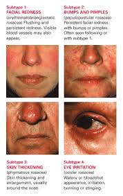 dietary rosacea