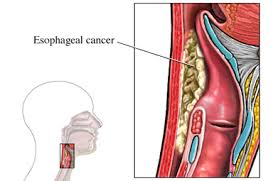 Esophageal Cancer