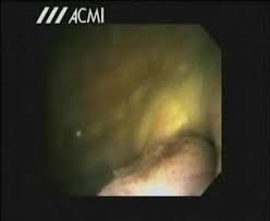 cystoscopy video