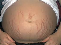 stretchmarks