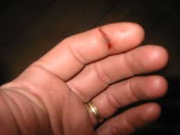 finger cut