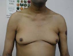 gynecomastia