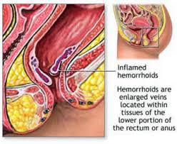 hemorroid treatment