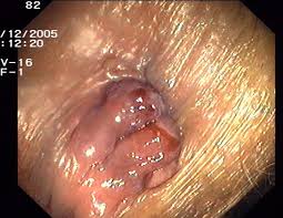 hemorroid treatment