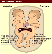 the siamese twins