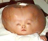 congenital hydrocephalus