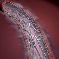 Drug-eluting stents found to