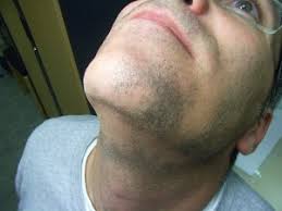 beard alopecia