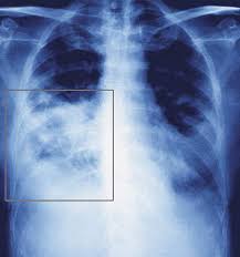 How to Cure Pneumonia