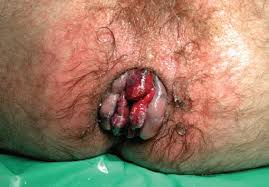 hemorroid treatment