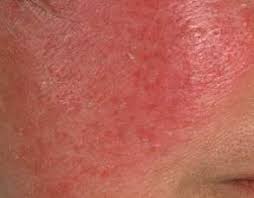 dietary rosacea