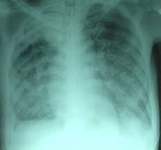 tuberculose miliaire