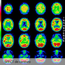 spect cerebral