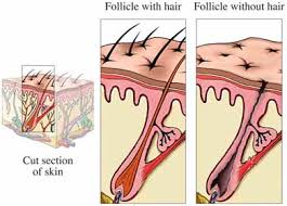 alopecia picture