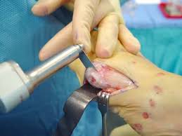 bunion operation