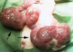 uterus cancer