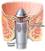 hemorroid treatment