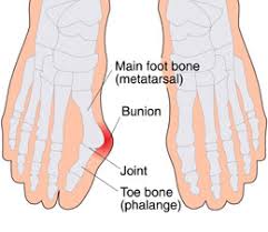 bunion operation