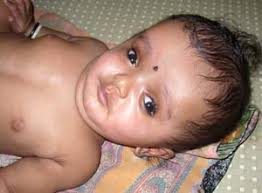 congenital hydrocephalus