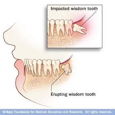 wisdom teeth