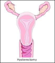 hysterectomy pics
