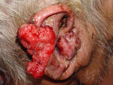 ear cancer
